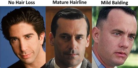 The Mature Hairline Explained - Are You Balding or Maturing?