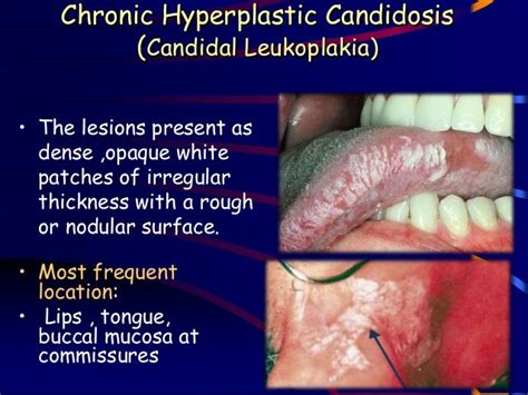 Oral mycotic infections