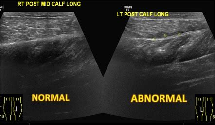 Gastrocnemius Tear Ultrasound