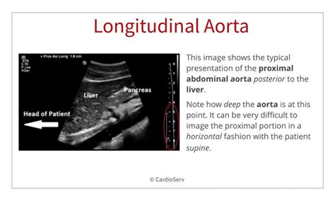 Abdominal Ultrasound for Echocardiographers: Aorta and IVC Cardioserv