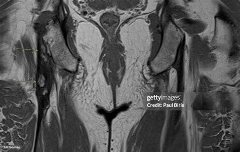 Mri T1 Appearance Of The Proximal Hamstring Tendinopathy With ...