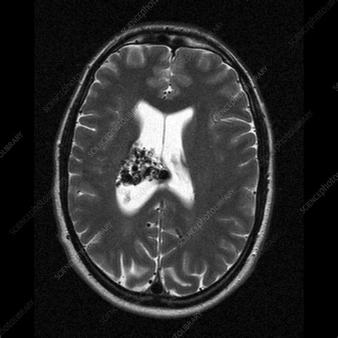 Brain arteriovenous malformation, MRI - Stock Image - M136/0298 - Science Photo Library