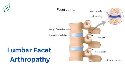 Spinalogy Clinic: Expert Care for Lumbar Facet Arthropathy | Best Back Pain, Slip Disc, Knee ...