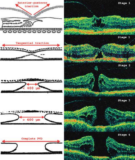 Value of internal limiting membrane peeling in surgery for idiopathic ...