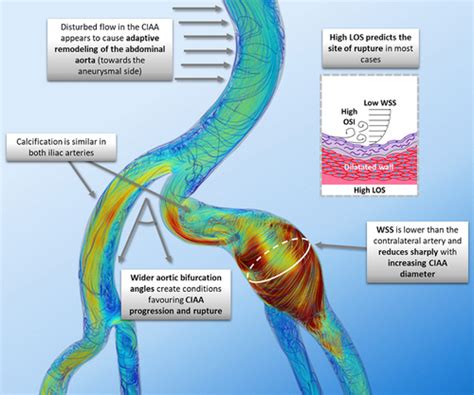 Morphology and Hemodynamics in Isolated Common Iliac Artery Aneurysms ...