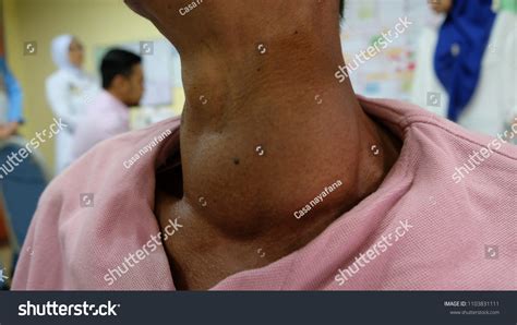 Huge Anterior Neck Swelling Left Thyroid Stock Photo (Edit Now) 1103831111