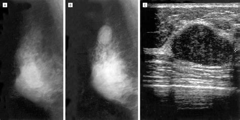 Diagnosis and Treatment of Breast Fibroadenomas by Ultrasound-Guided ...