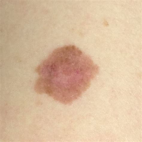 Melanoma Skin Cancer On Arm