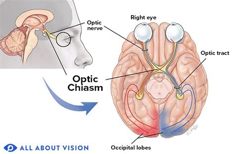 Optic Chiasm - All About Vision