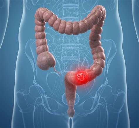 Colorectal Cancer Non-Conventional Therapies- PeopleBeatingCancer