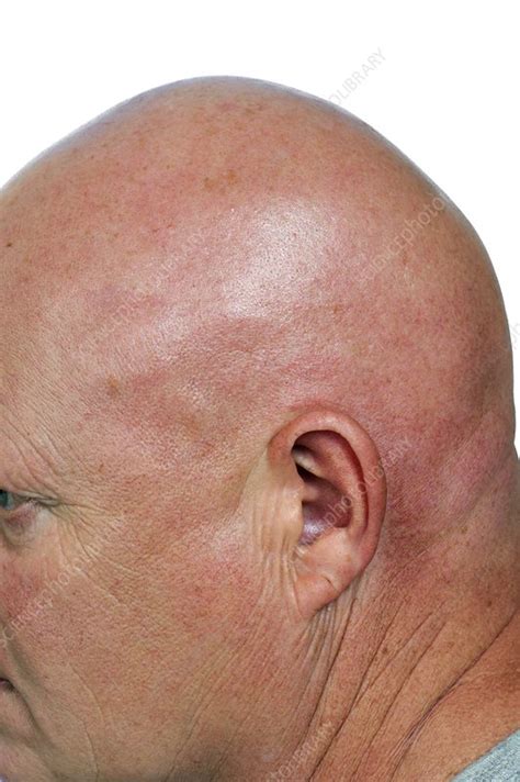 Hair loss in alopecia totalis - Stock Image - C011/5495 - Science Photo ...