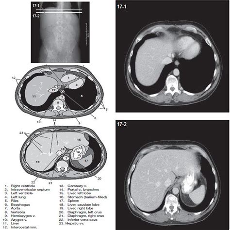 Ct Scan Whole Abdomen With Contrast Price In Philippines - fodderstory