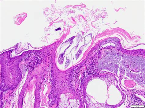 Eosinophilic Pustular Folliculitis Histology