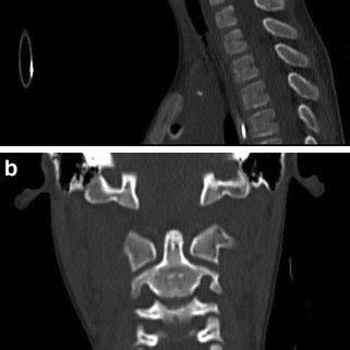 X-ray demonstrating C2 on C3 pseudosubluxation | Download Scientific Diagram