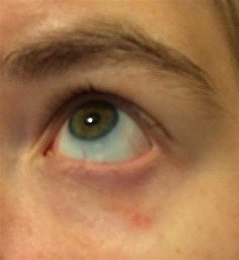 [Skin Concerns] Redness and bumps under eye, went to optometrist and it ...