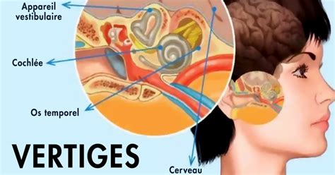 Labyrinthitis. Symptoms, causes and treatments - Archynewsy