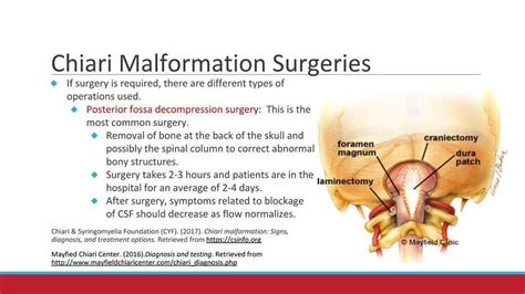 Chiari Malformation (#CM) – Chiari Malformation Surgeries If surgery is ...