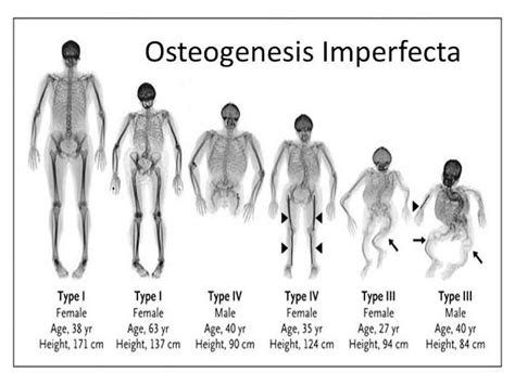 Osteogenesis Imperfecta Treatment