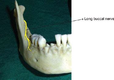 Long Buccal Nerve Block