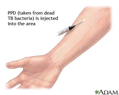 PPD skin test | UF Health, University of Florida Health