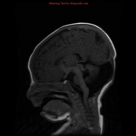 Joubert syndrome | Image | Radiopaedia.org