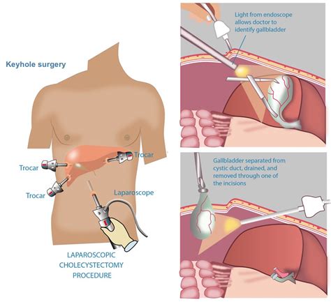 Gallbladder Procedures - General and Hepato-Pancreato-Biliary Surgeon