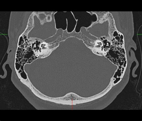 CT Petrous Temporal Bone | Precise Radiology