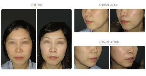 Philtrum Reduction-Facial Surgery | Wish Aesthetic Surgery Clinic