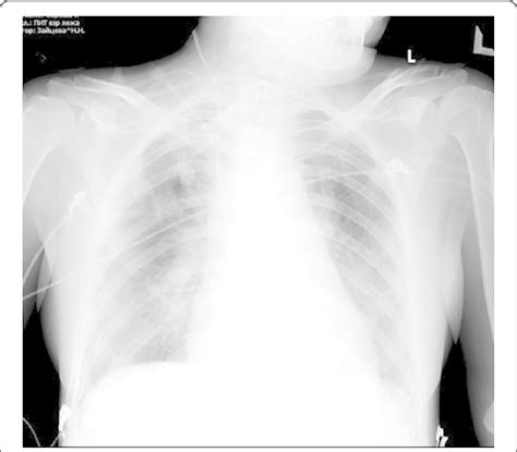 Chest X-ray: reperfusion pulmonary oedema after pulmonary... | Download ...