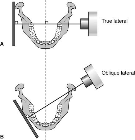 12: Oblique lateral radiography | Pocket Dentistry