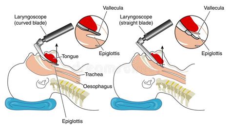 Inserting A Laryngoscope Stock Photos - Image: 12592703