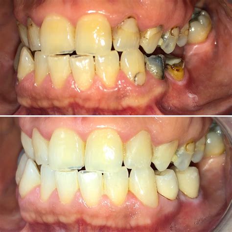 This is what 30 years of smoking did to my teeth. Shame and embarrassment every time I went to ...