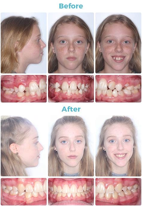 Before and After Orthodontic Treatment Photos | David Ross Ortho