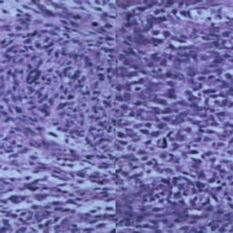 Pathology confirmed the diagnosis of a spindle cell sarcoma in the left... | Download Scientific ...