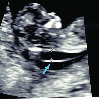 First trimester ultrasound showing fetal thickened nuchal translucency... | Download Scientific ...