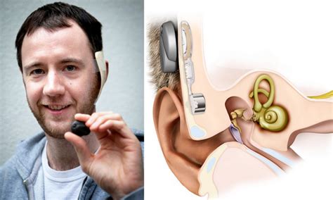 The man with the bionic ear: Pioneering implant placed under the skin could restore the hearing ...