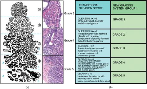 Classification of prostate cancer; (a): Gleason grading system, (b):... | Download Scientific ...