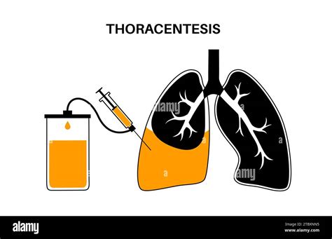 Thoracentesis medical procedure, illustration Stock Photo - Alamy