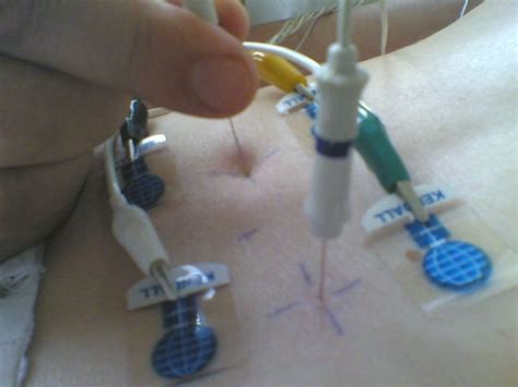 Emg test painful - bathret