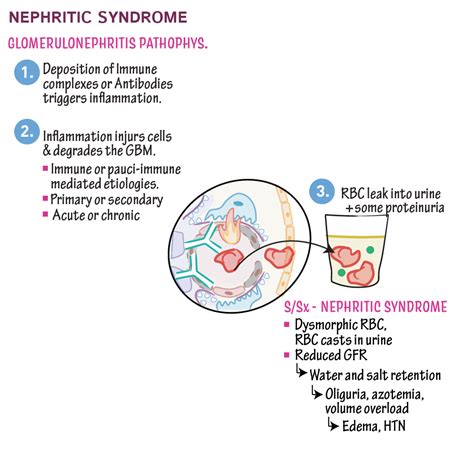 Pathology Glossary: Nephritic Syndrome & Glomerulonephritis | Draw It to Know It