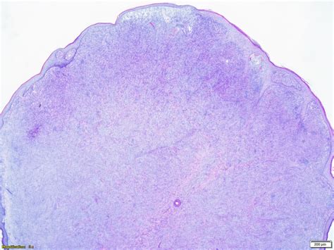 Dermatofibroma Histology