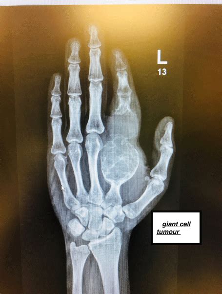 Giant cell tumour of the hand presenting as trauma to the ED