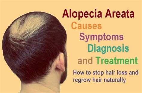 What Is Alopecia Hair Loss / Alopecia Areata A Comprehensive Review Of ...