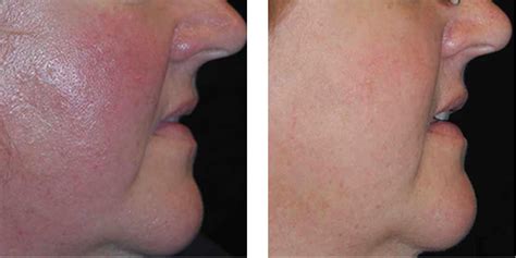 Laser Genesis Before And After Acne Scars at Armando Stokes blog