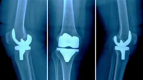 Knee Replacement Complications | Problems After Knee Surgery