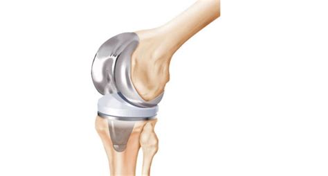 Review: Zimmer Persona Total Knee Replacement System