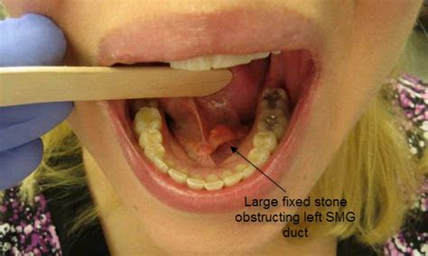 Salivary gland atrophy with chronic obstruction | Iowa Head and Neck Protocols