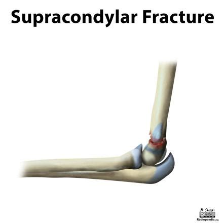 Supracondylar humeral fracture | Radiology Reference Article ...