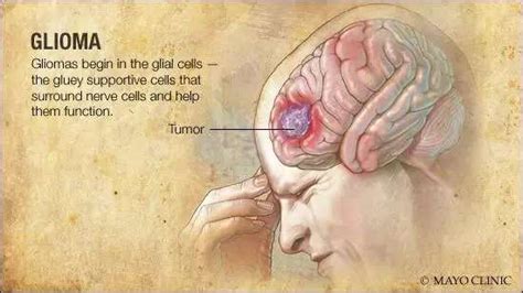 Research provides critical information about size and growth speed of gliomas