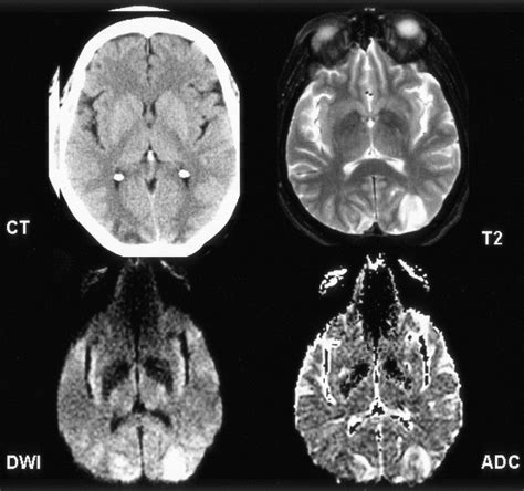 Cortical blindness: Clinical and radiologic findings in reversible posterior leukoencephalopathy ...